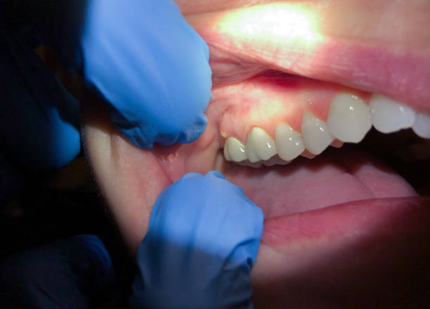 Best Emergency Dental Care for Broken or Chipped Teeth in Liberty, SC